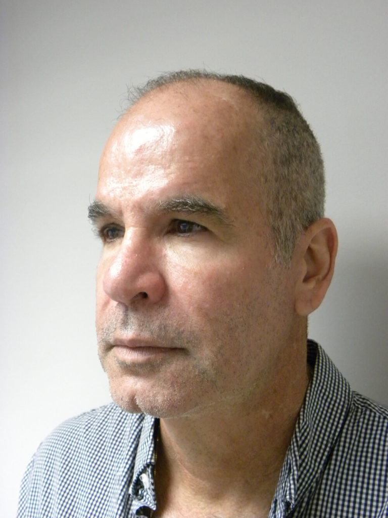 Male Neck Lift Before and After Pictures Miami, FL