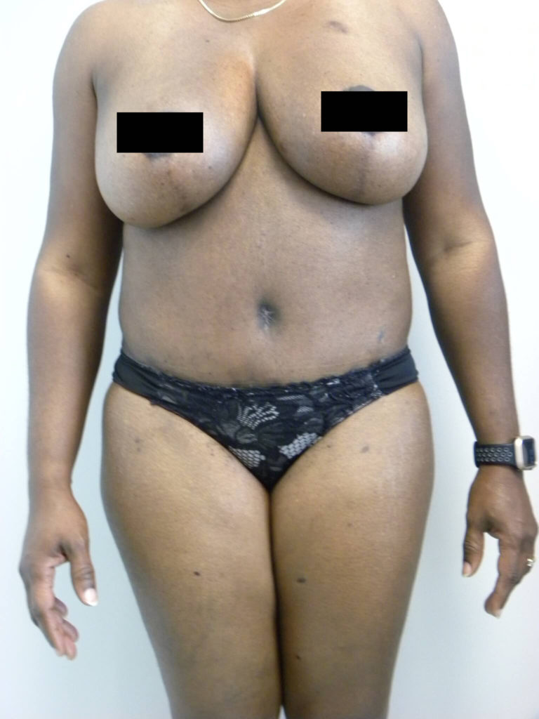 Tummy Tuck Before and After Pictures Miami, FL