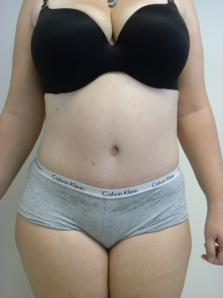 Tummy Tuck Before and After Pictures in Miami, FL