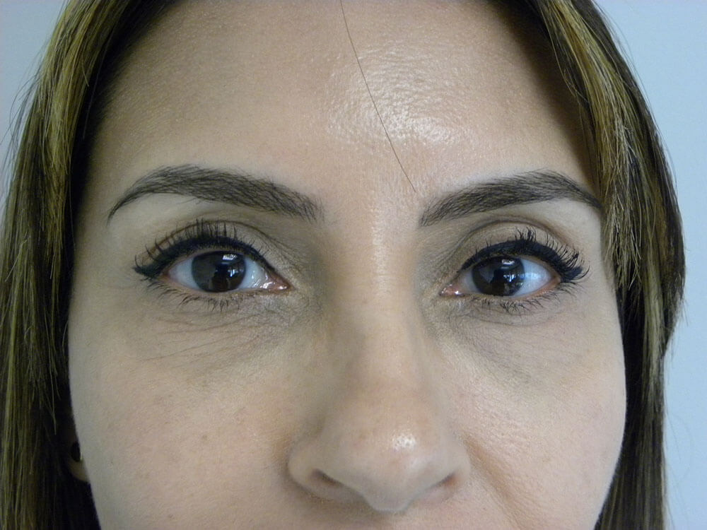 Blepharoplasty Before and After Pictures in Miami, FL