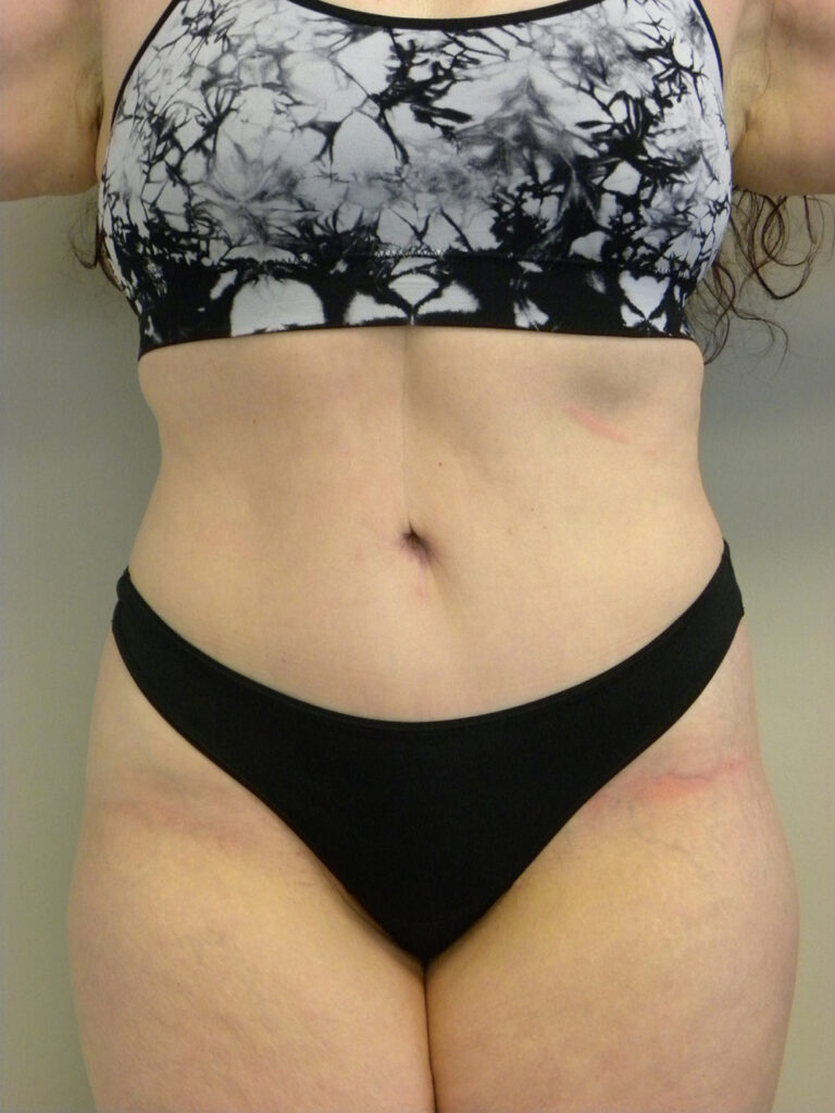Body Lift Before and After Pictures Miami, FL