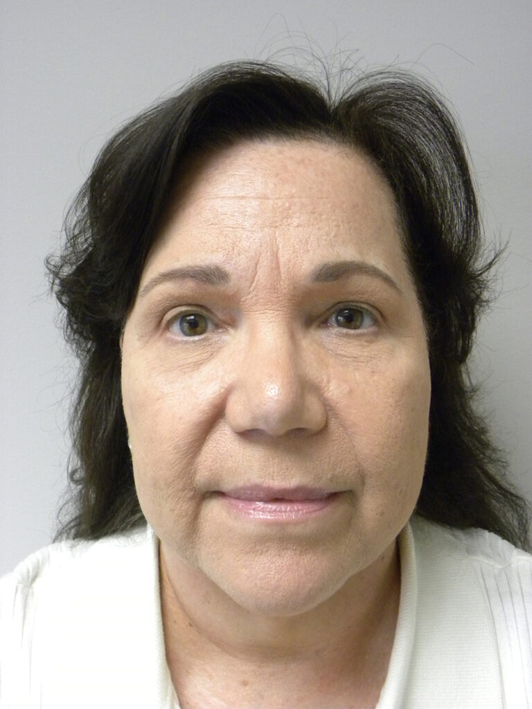 BLEPHAROPLASTY BEFORE AND AFTER PICTURES IN MIAMI, FL