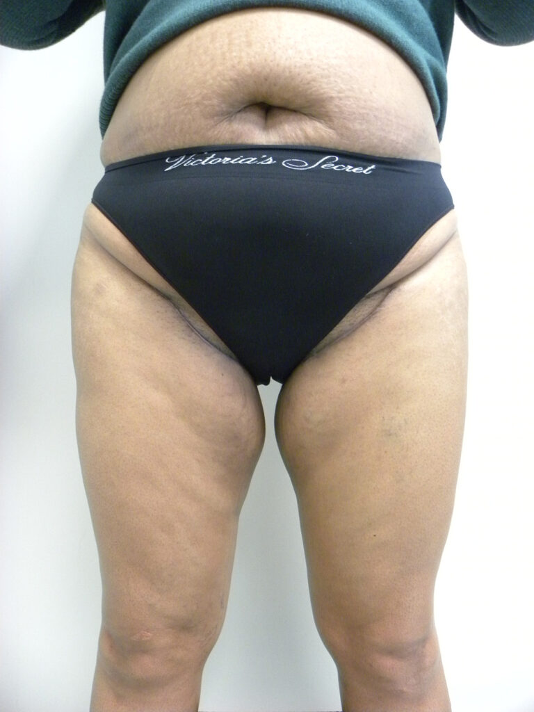 Thigh Lift Before and After Pictures in Miami, FL