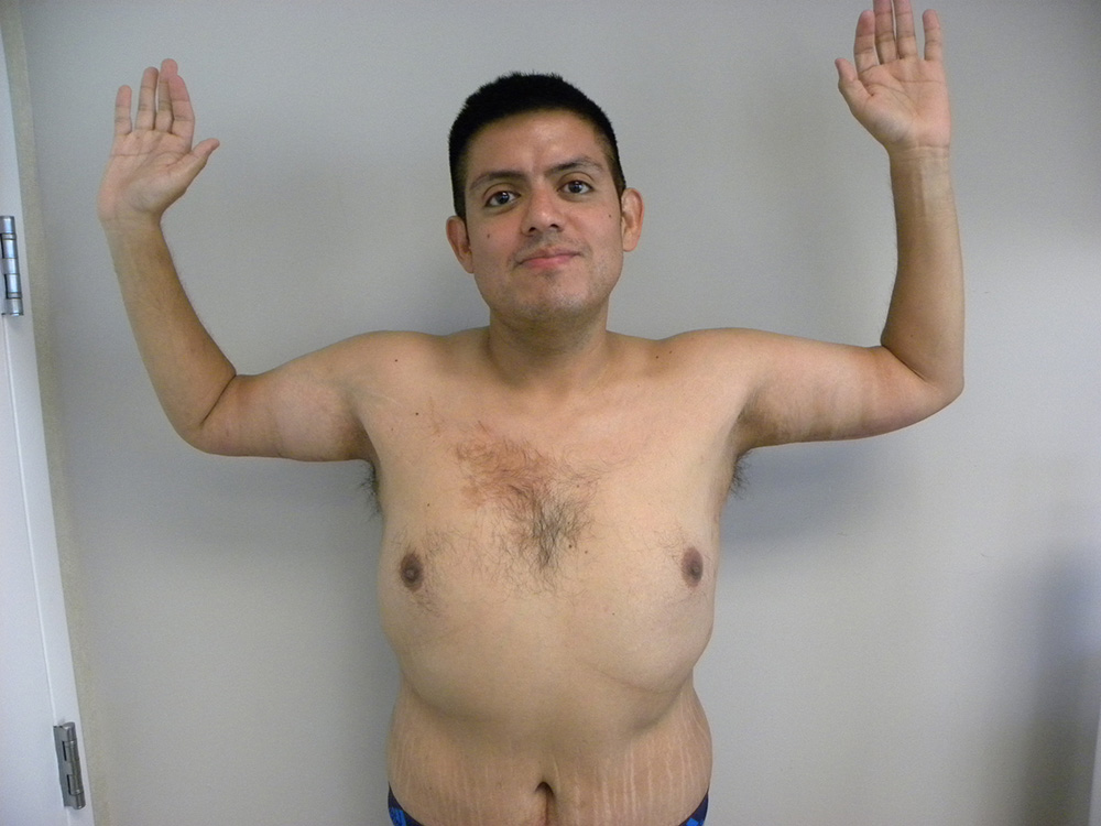 Arm Lift Before and After Pictures Miami, FL