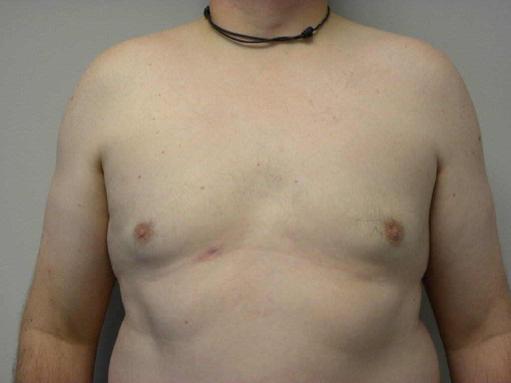 Plastic Surgery Before and After Pictures in Miami, FL - Dr. Adam J. Rubinstein 