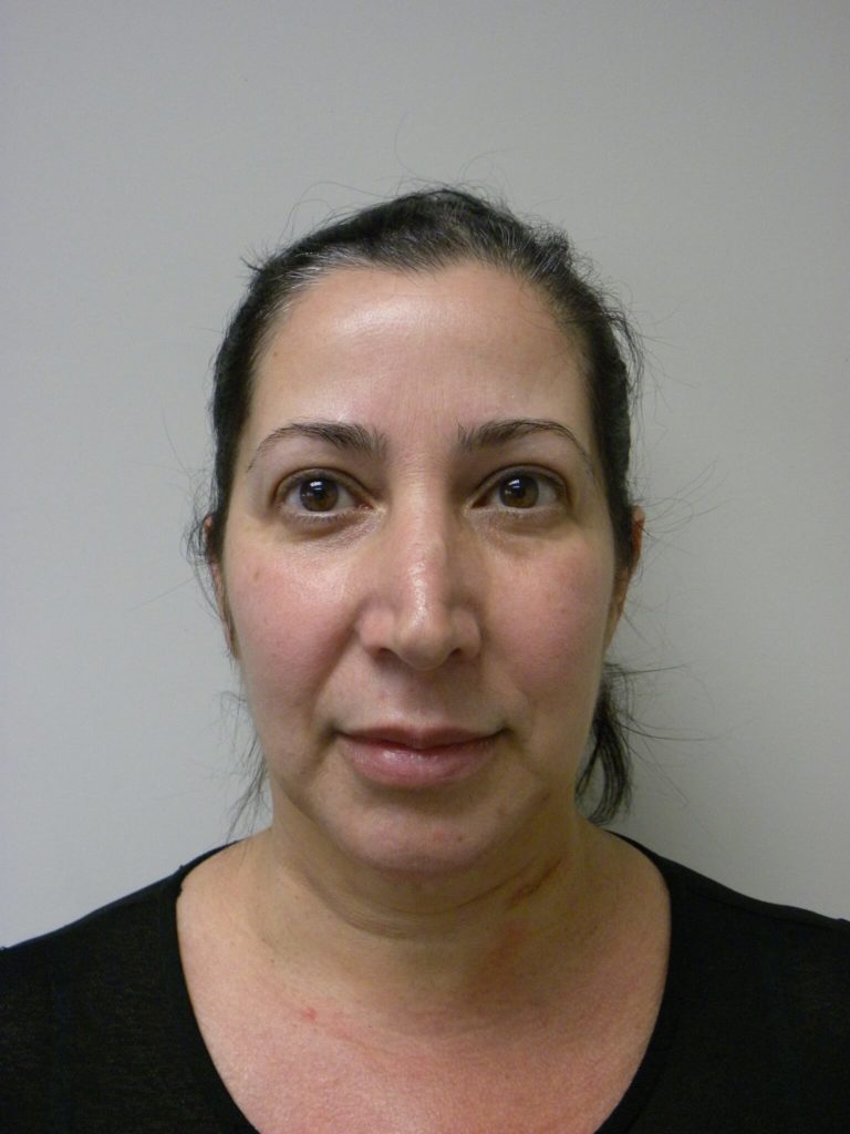 Neck Lift Before and After Pictures Miami, FL