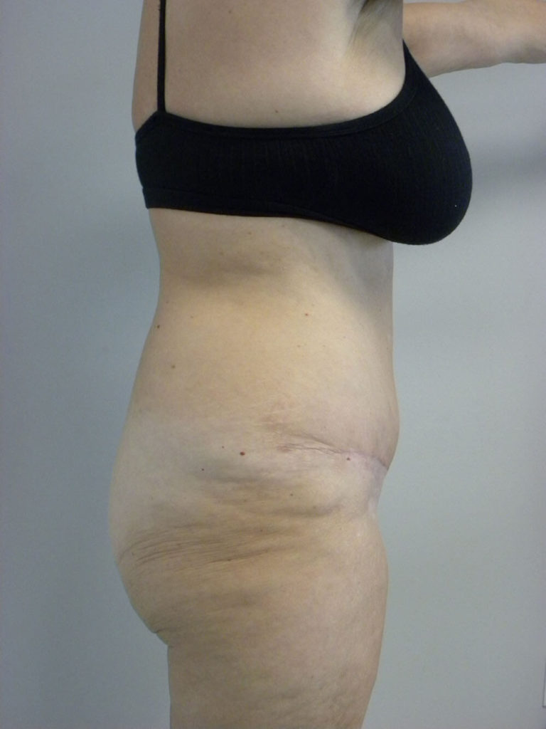 Tummy Tuck Before and After Pictures in Miami, FL