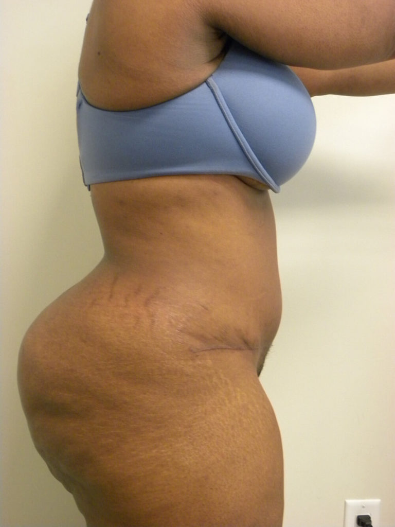 Tummy Tuck Before and After Pictures in Miami, FL