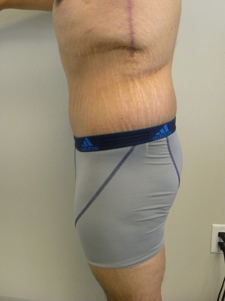 Plastic Surgery Before and After Pictures in Miami, FL - Dr. Adam J. Rubinstein 