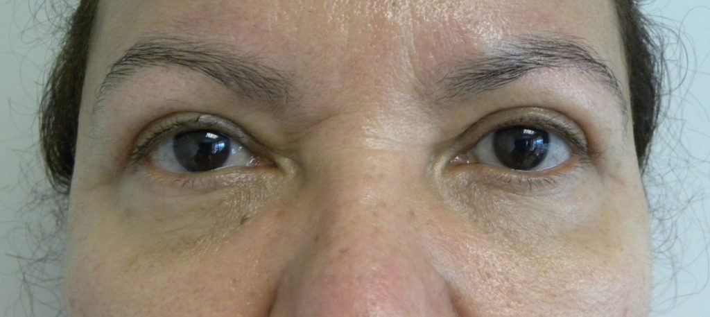 Blepharoplasty Before and After Pictures in Miami, FL