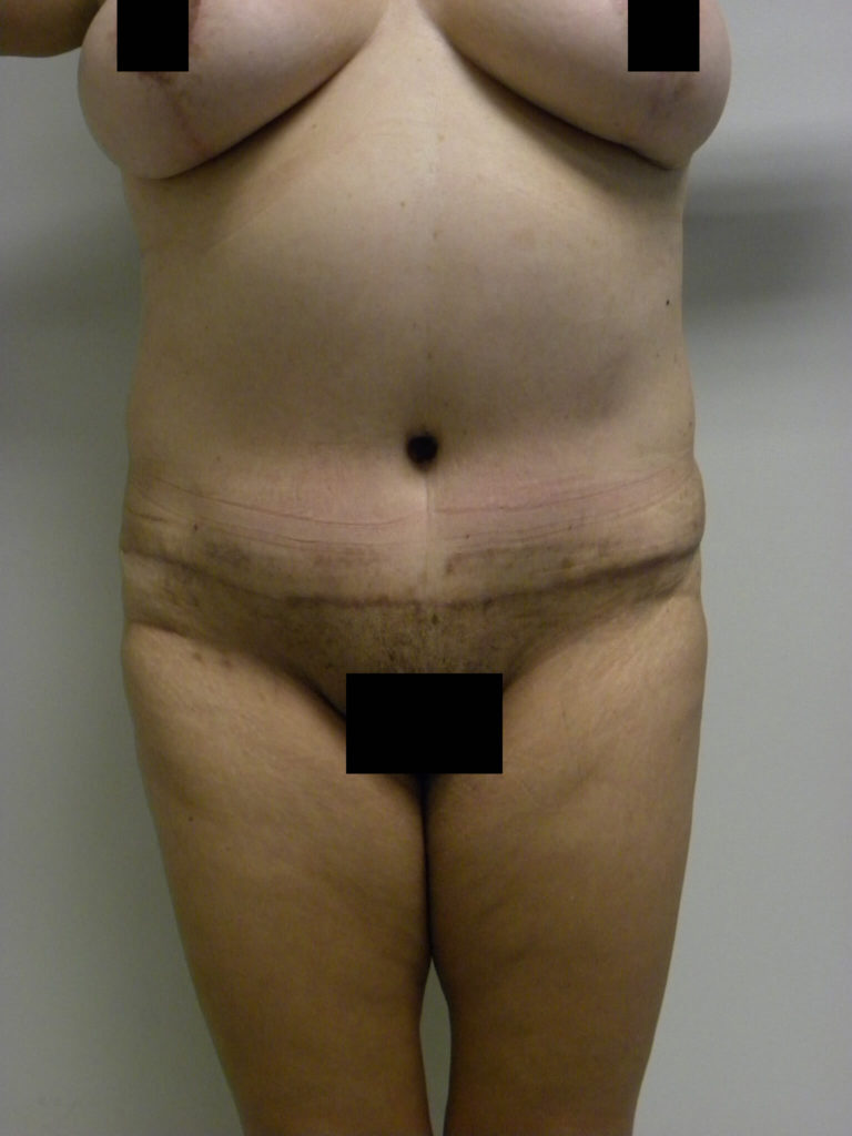 Tummy Tuck Before and After Pictures in Miami, FL