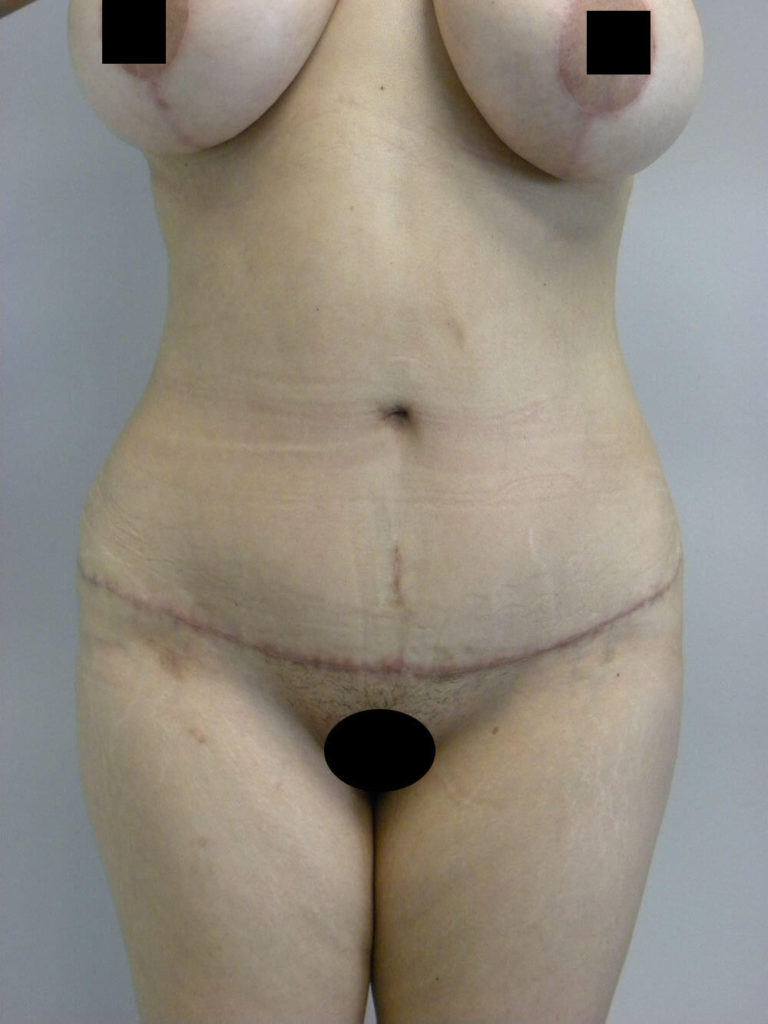 Tummy Tuck Before and After Pictures in Miami, FL