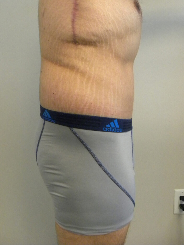 Plastic Surgery Before and After Pictures in Miami, FL - Dr. Adam J. Rubinstein 