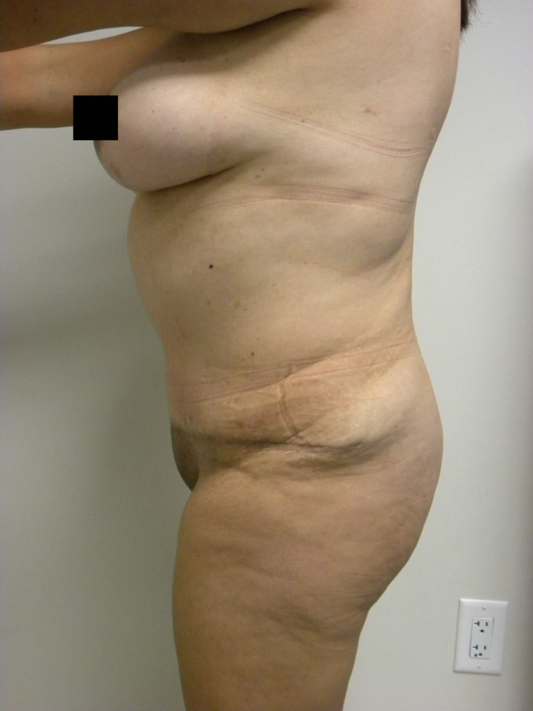 Tummy Tuck Before and After Pictures in Miami, FL