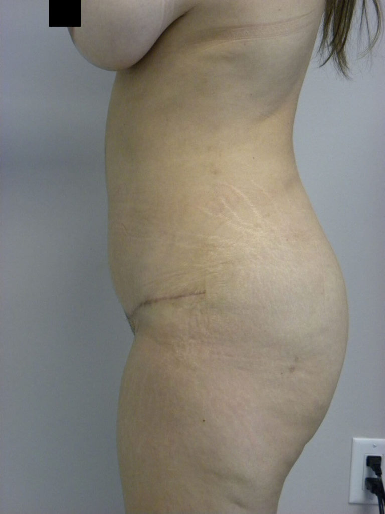 Tummy Tuck Before and After Pictures in Miami, FL