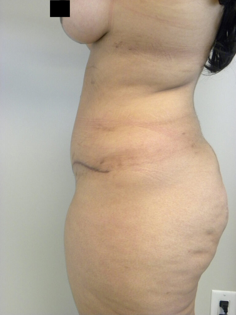 Tummy Tuck Before and After Pictures in Miami, FL