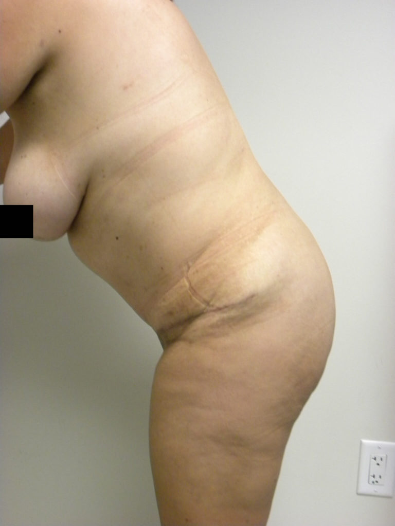 Tummy Tuck Before and After Pictures in Miami, FL