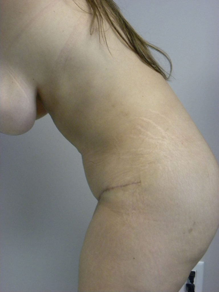 Tummy Tuck Before and After Pictures in Miami, FL