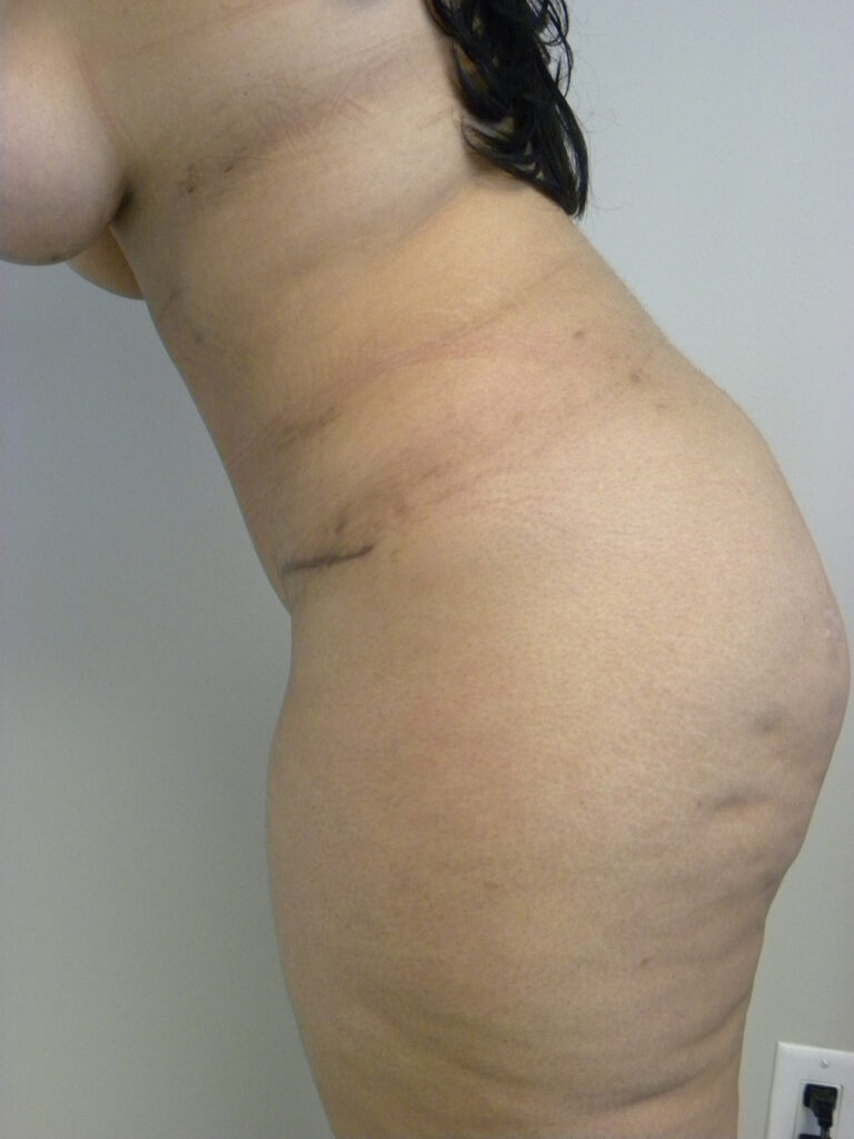 Tummy Tuck Before and After Pictures in Miami, FL