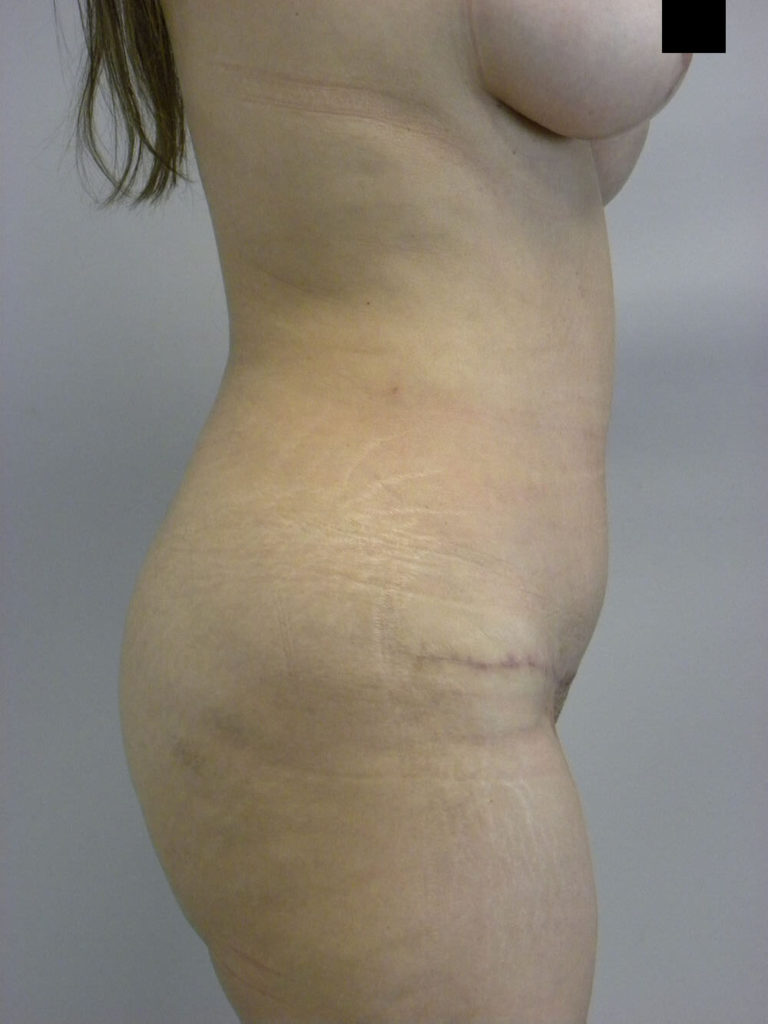 Tummy Tuck Before and After Pictures in Miami, FL