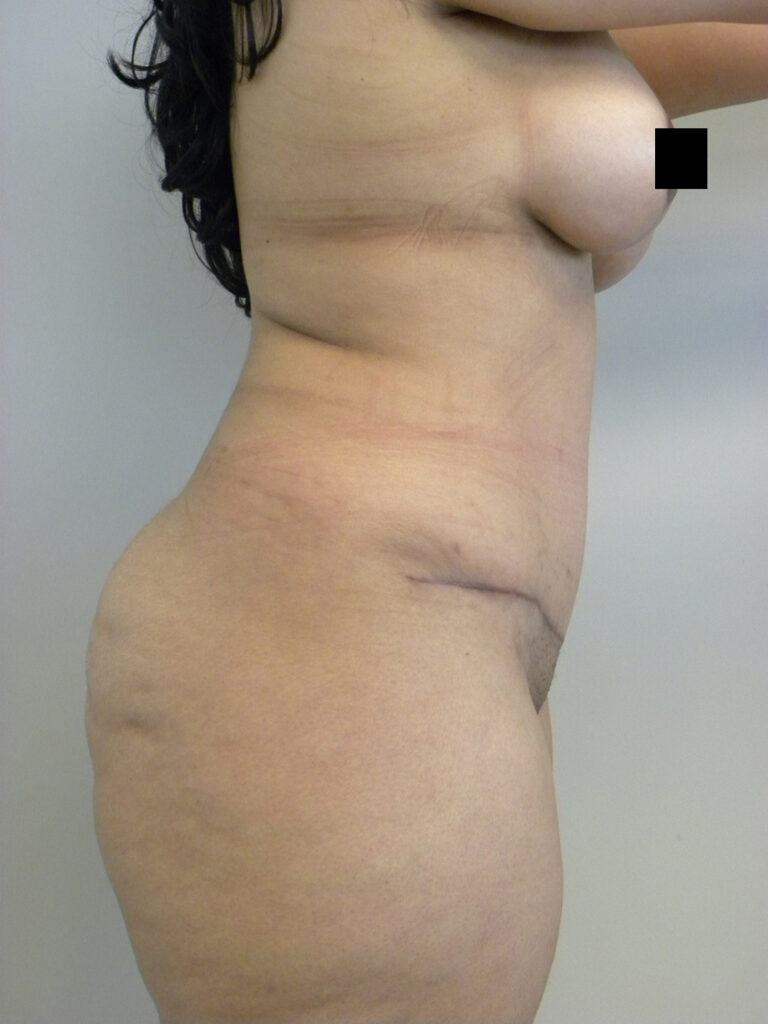 Tummy Tuck Before and After Pictures in Miami, FL