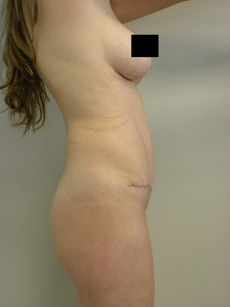 Tummy Tuck Before and After Pictures in Miami, FL