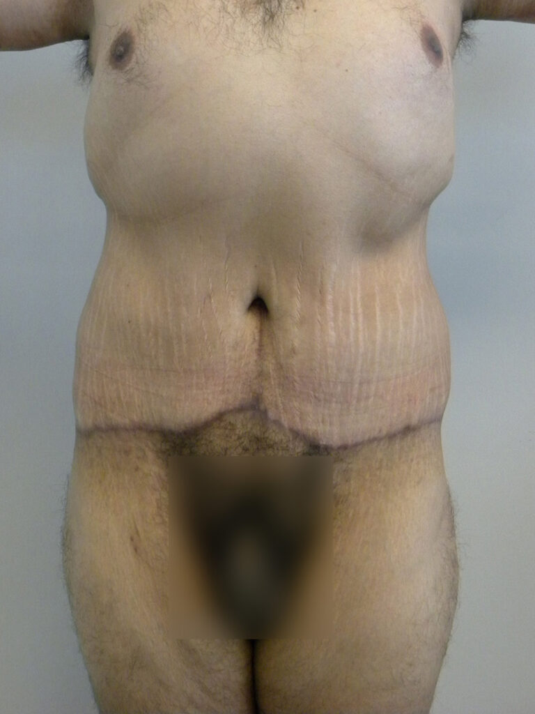 Plastic Surgery Before and After Pictures in Miami, FL - Dr. Adam J. Rubinstein 