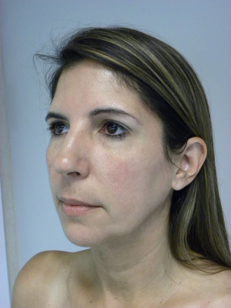 Minimally Invasive Neck Lift with Ellevate Before and After Pictures Miami, FL