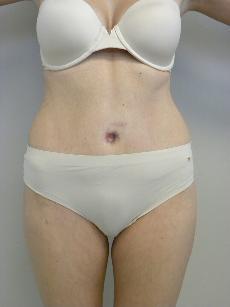 Tummy Tuck Before and After Pictures in Miami, FL