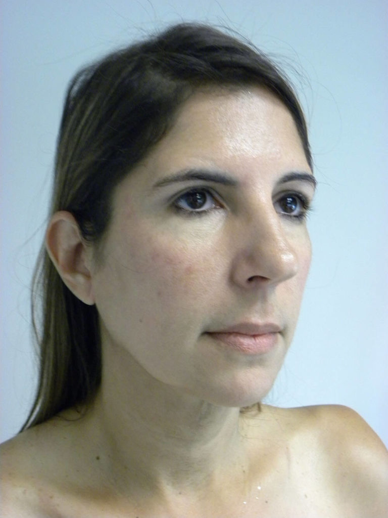 Neck Lift Before and After Pictures Miami, FL