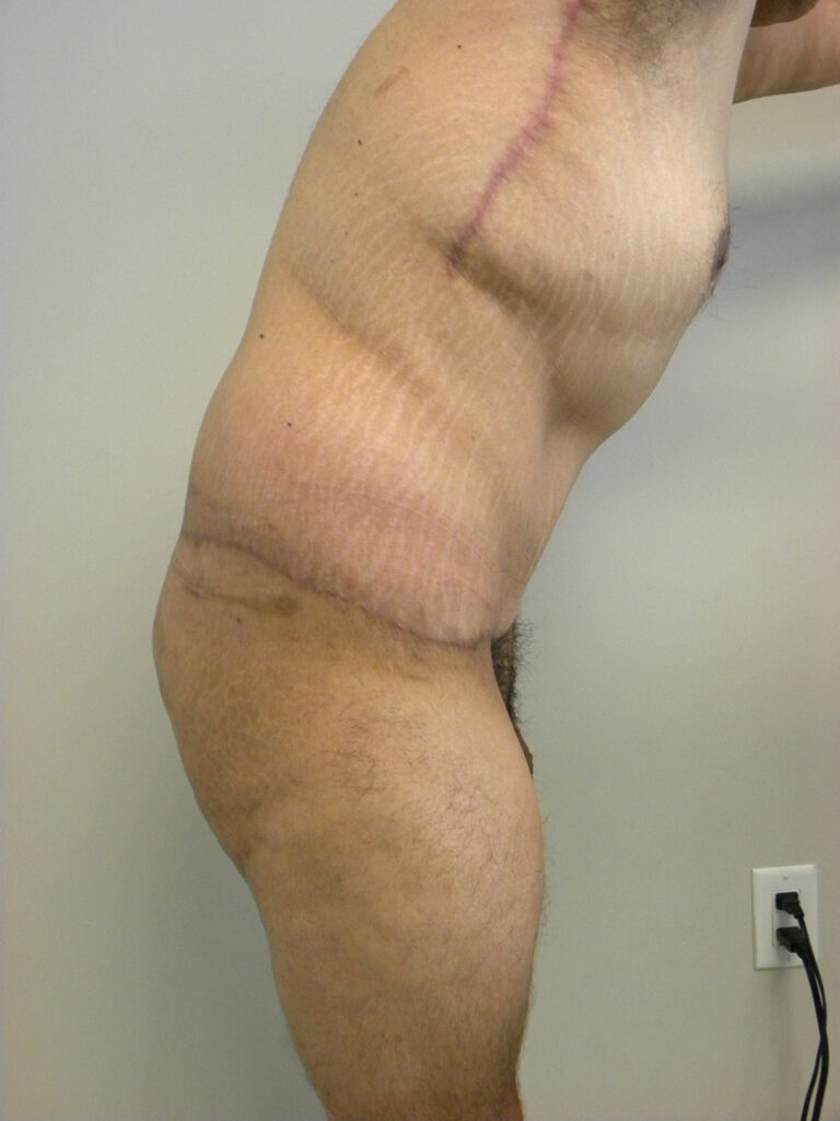 Plastic Surgery Before and After Pictures in Miami, FL - Dr. Adam J. Rubinstein 