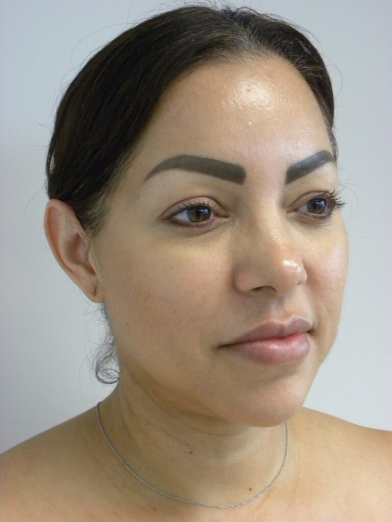 Plastic Surgery Before and After Pictures in Miami, FL - Dr. Adam J. Rubinstein 