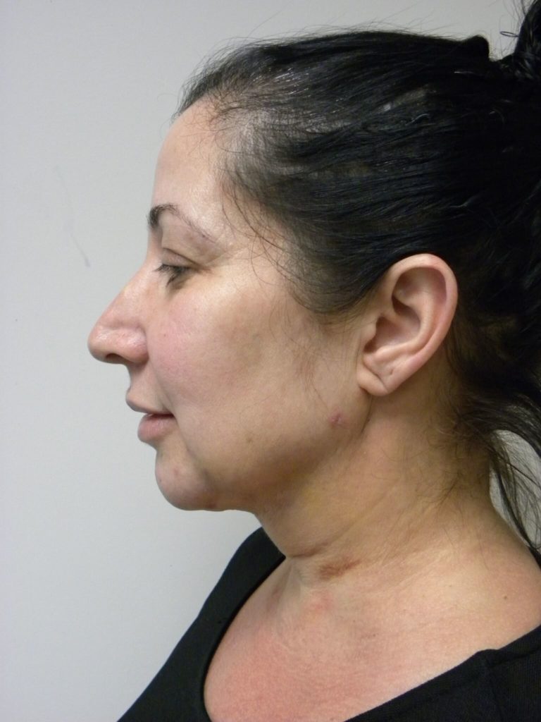 Minimally Invasive Neck Lift with Ellevate Before and After Pictures Miami, FL