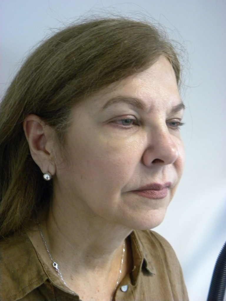 Neck Lift Before and After Pictures Miami, FL