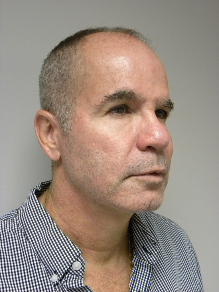 Neck Lift Before and After Pictures Miami, FL