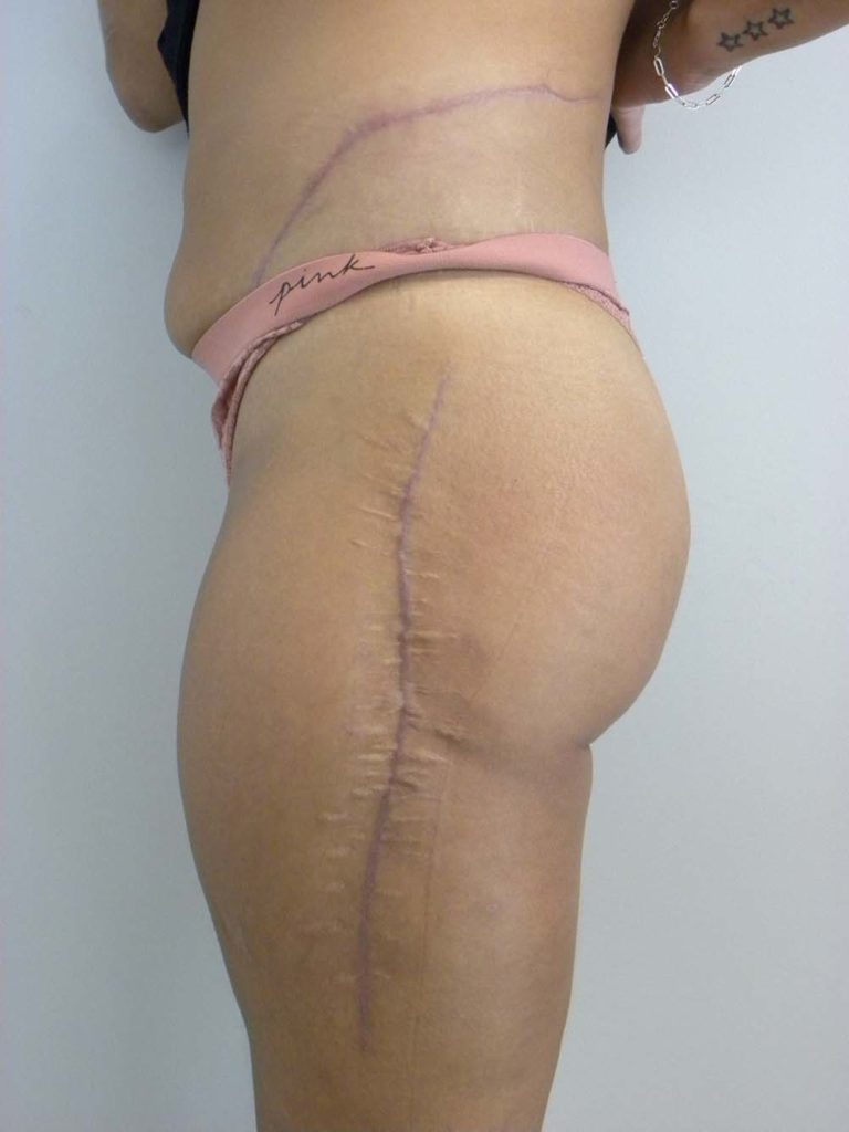 Scar Revision Before and After Pitcures in Miami, FL