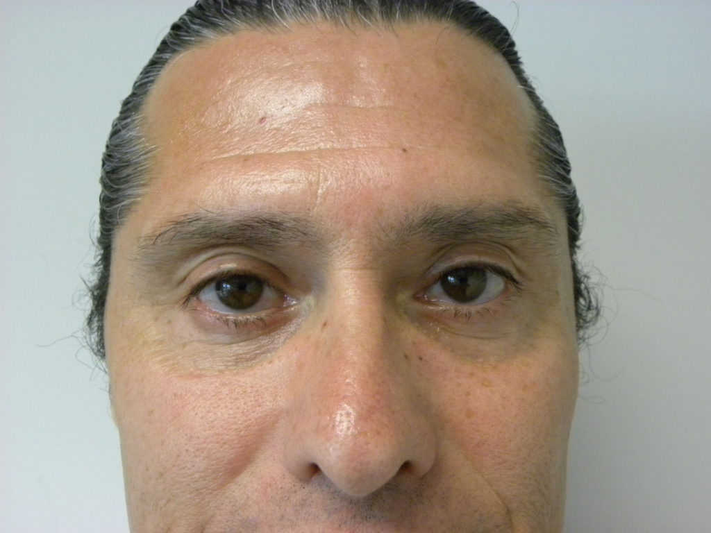 Blepharoplasty Before and After Pictures in Miami, FL