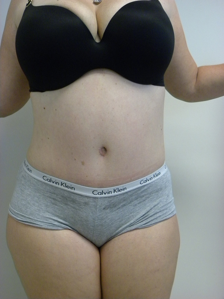 Tummy Tuck Before and After Pictures in Miami, FL