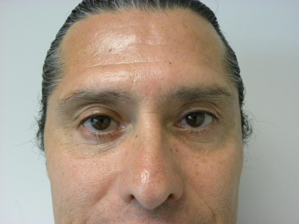 Male Blepharoplasty Before and After Pictures Miami, FL