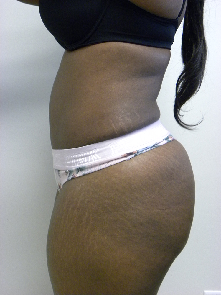 Tummy Tuck Before and After Pictures in Miami, FL