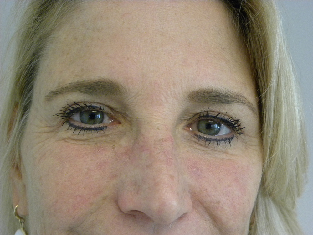 BLEPHAROPLASTY BEFORE AND AFTER PICTURES IN MIAMI, FL