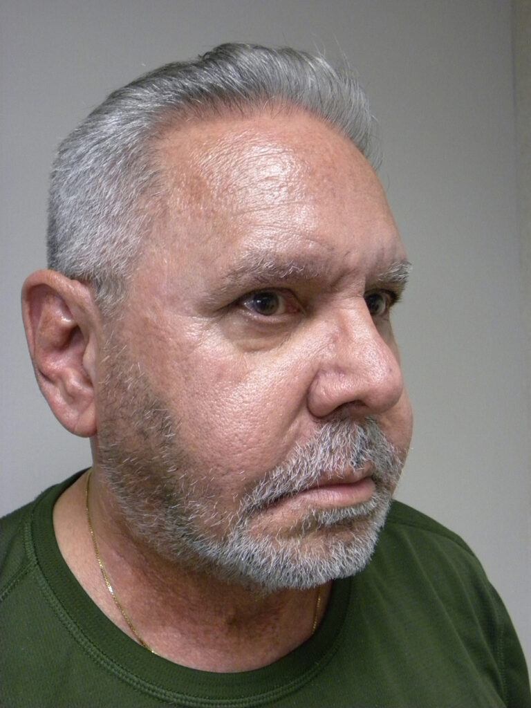 Neck Lift Before and After Pictures Miami, FL