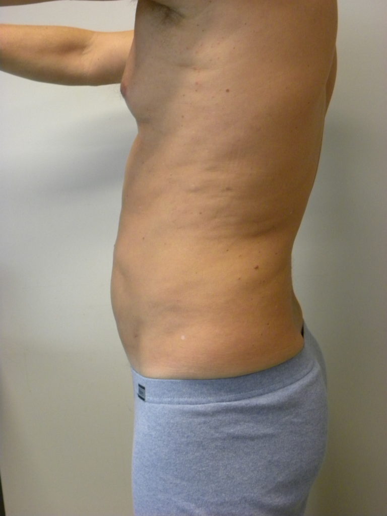 LIPOSUCTION BEFORE AND AFTER PICTURES IN MIAMI, FL