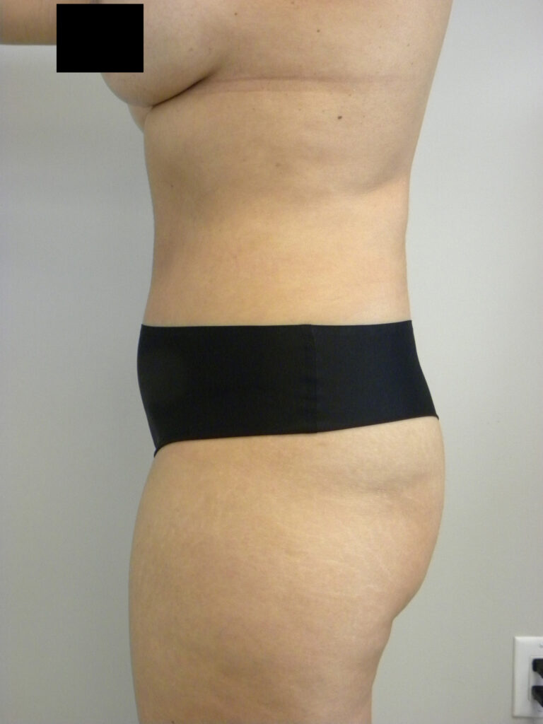 TUMMY TUCK BEFORE AND AFTER PICTURES IN MIAMI, FL