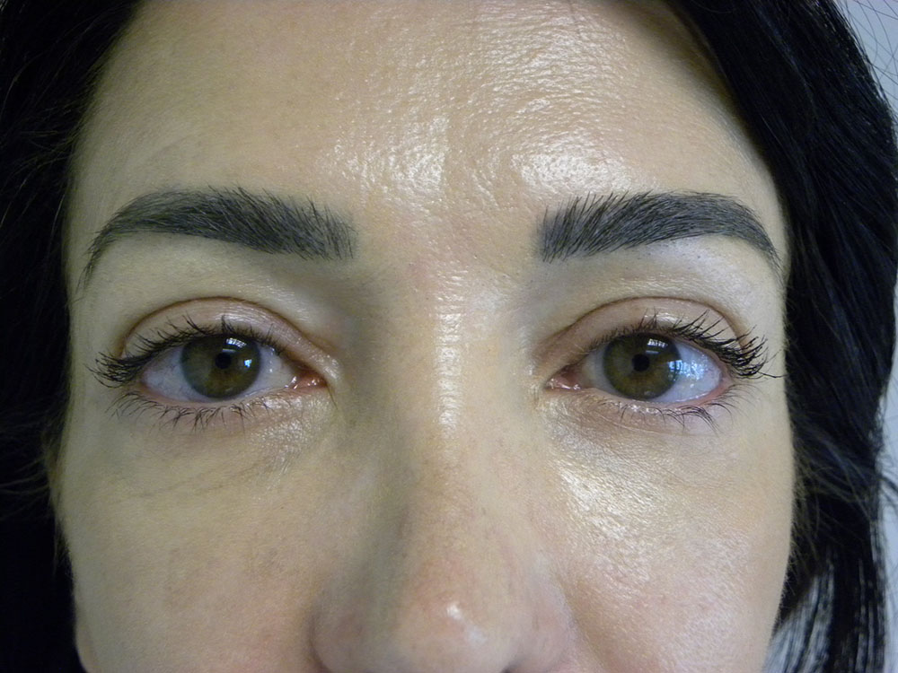 BLEPHAROPLASTY BEFORE AND AFTER PICTURES IN MIAMI, FL