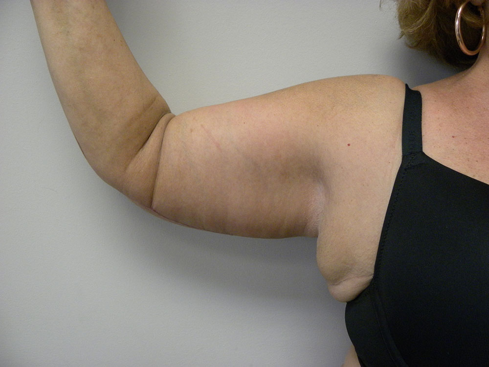 ARM LIFT BEFORE AND AFTER PICTURES IN MIAMI, FL