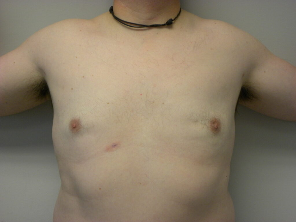 Plastic Surgery Before and After Pictures in Miami, FL - Dr. Adam J. Rubinstein 