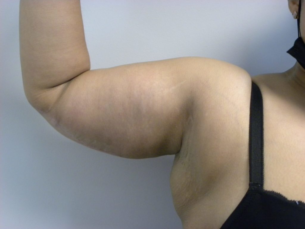 Arm Lift Before and After Pictures Miami, FL