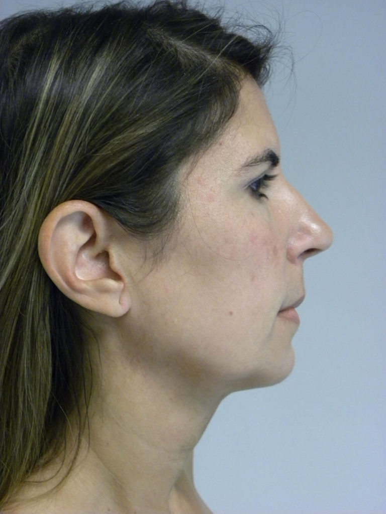 CHIN IMPLANT BEFORE AND AFTER PICTURES IN MIAMI, FL