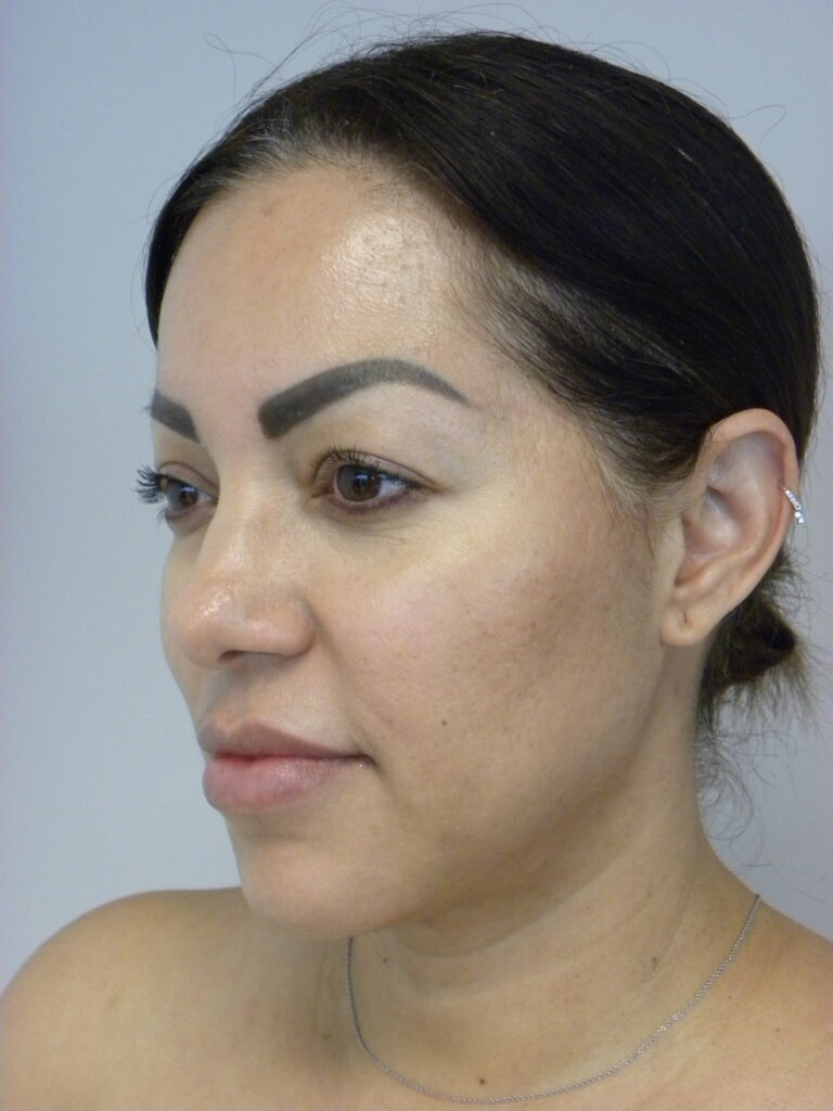 MINIMALLY INVASIVE NECK LIFT WITH ELLEVATE BEFORE AND AFTER PICTURES IN MIAMI, FL